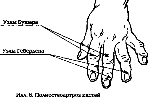 Узелки бушара лечение. Артроз кистей рук,узлы Бушара. Узелки Гебердена и Бушара. Узлы Гебердена и Бушара на рентгене. Узлы Бушара на пальце руки.